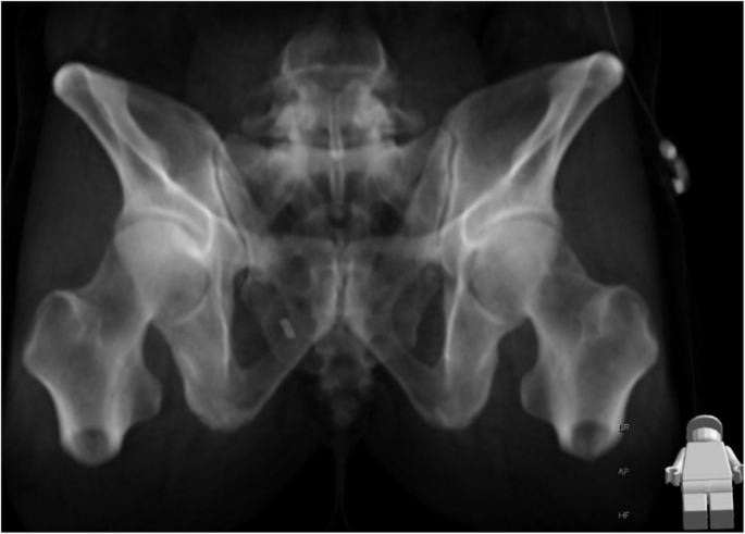 Feasibility of iliosacral screw placement in patients with upper sacral  dysplasia | Journal of Orthopaedic Surgery and Research | Full Text