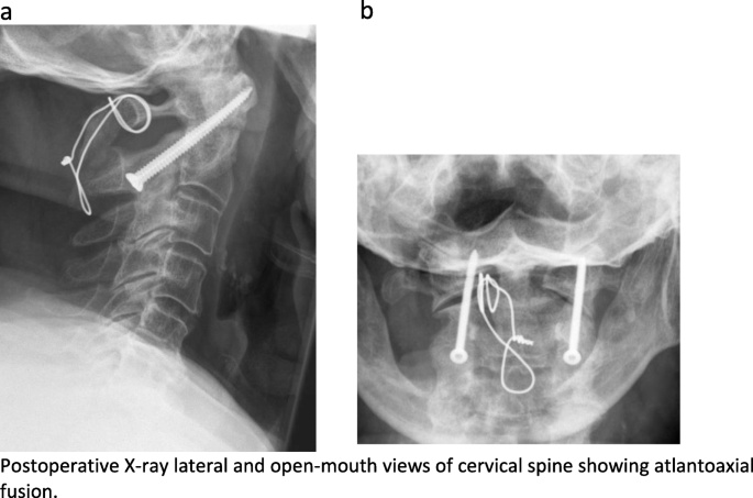 Does Isolated Atlantoaxial Fusion Result In Better Clinical Outcome Compared To Occipitocervical Fusion Journal Of Orthopaedic Surgery And Research Full Text