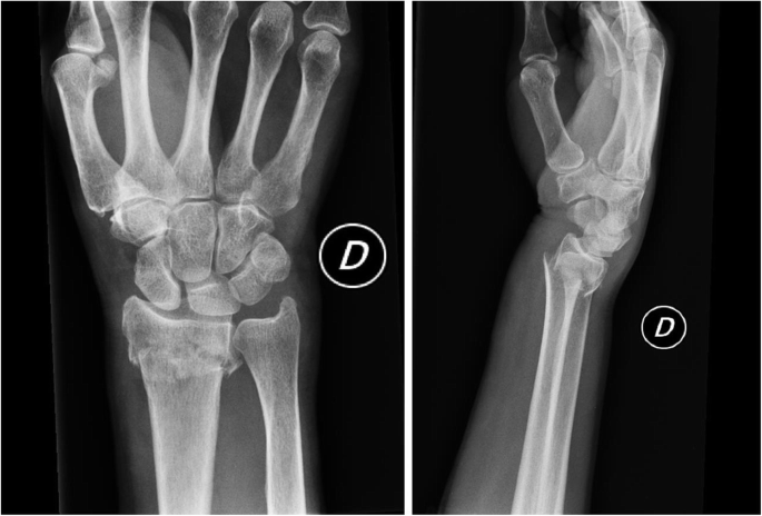 Below-elbow or above-elbow cast for conservative treatment of  extra-articular distal radius fractures with dorsal displacement: a  prospective randomized trial | Journal of Orthopaedic Surgery and Research  | Full Text