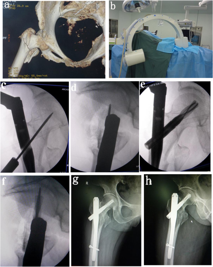 Comparison of two methods of locating proximal femoral nail anti-rotation  in the treatment of femoral intertrochanteric fractures | Journal of  Orthopaedic Surgery and Research | Full Text