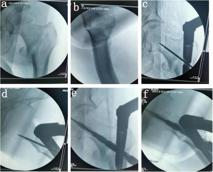 Comparison of two methods of locating proximal femoral nail anti-rotation  in the treatment of femoral intertrochanteric fractures | Journal of  Orthopaedic Surgery and Research | Full Text
