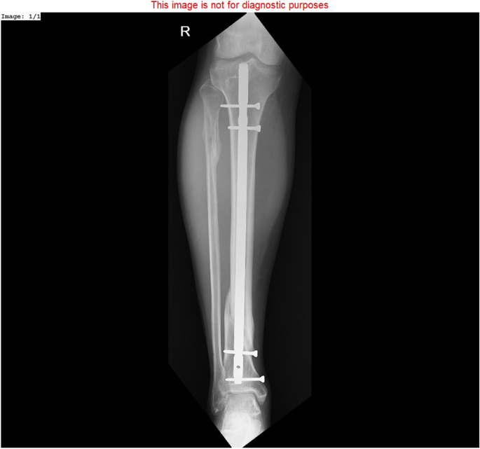 THE MANAGEMENT OF INFECTED NONUNION TIBIA SHAFT WITH ILIZAROV RING