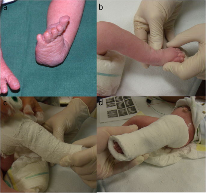 Clubfoot Treatment With Ponseti Method Parental Distress During Plaster Casting Journal Of Orthopaedic Surgery And Research Full Text