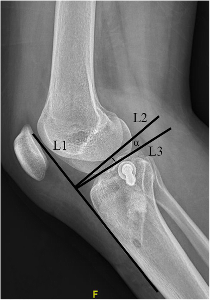 A Novel Arthroscopically Assisted Reduction Technique For Three Patterns Of Posterolateral Tibial Plateau Fractures Journal Of Orthopaedic Surgery And Research Full Text