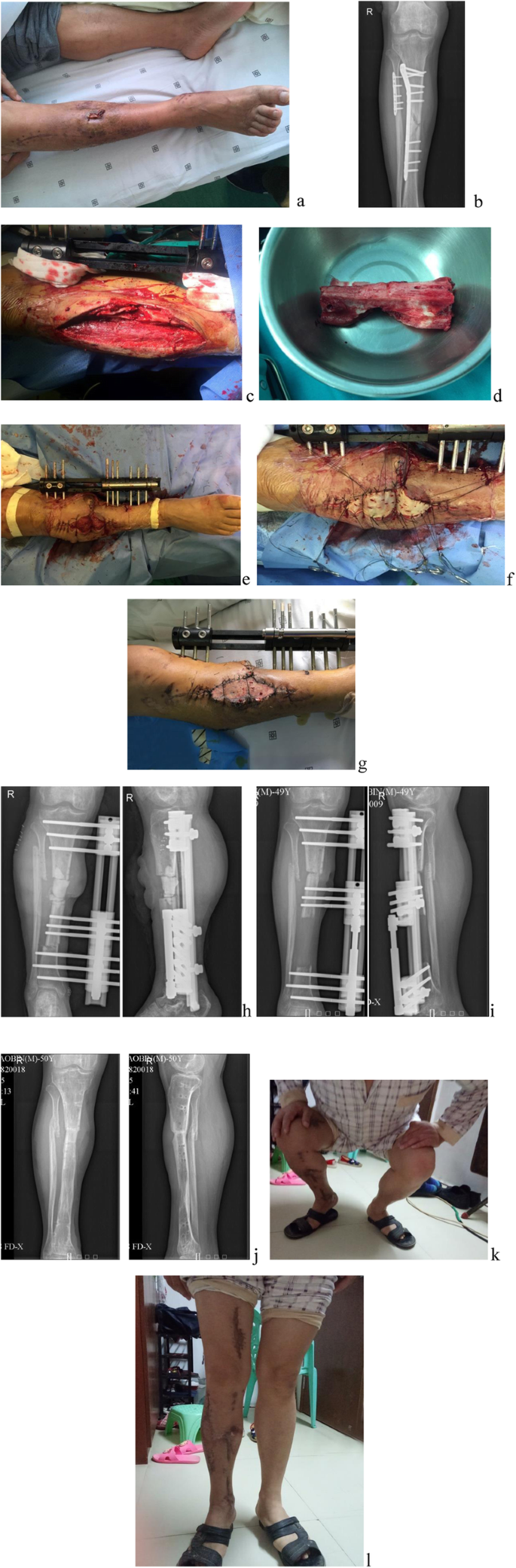 Management of post-traumatic bone defects of the tibia using vascularised  fibular graft combined with Ilizarov external fixator - ScienceDirect