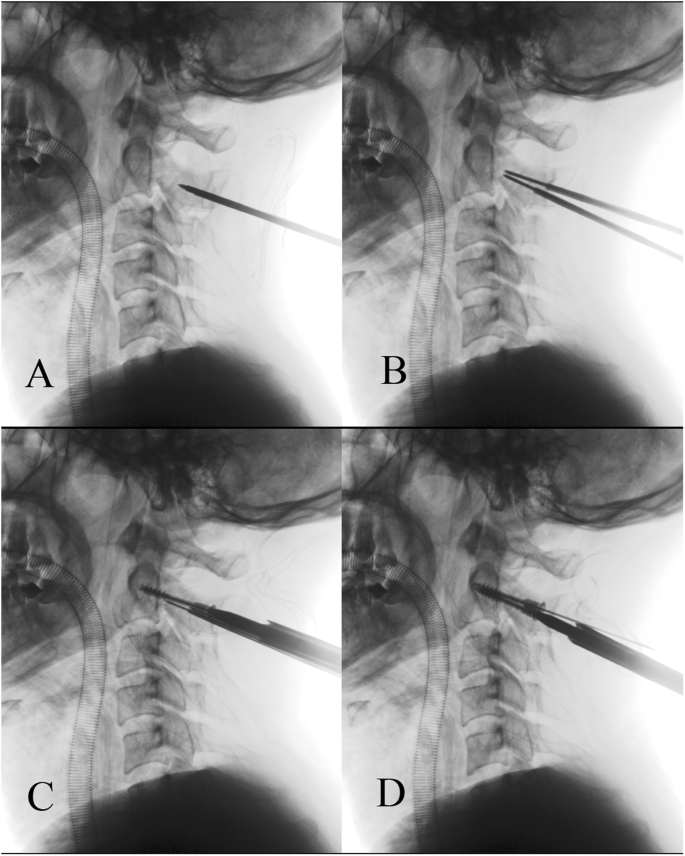 Odontoid and hangman fracture