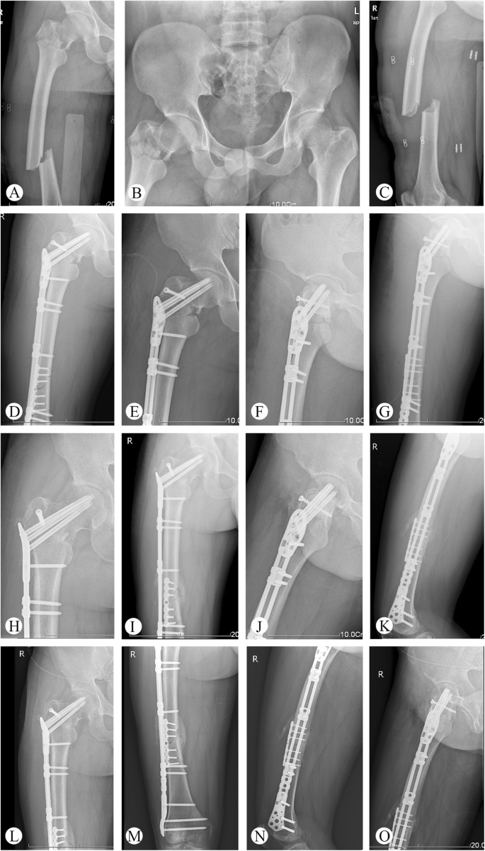 Ipsilateral Proximal And Shaft Femoral Fractures Treated With Bridge Link Type Combined Fixation System Journal Of Orthopaedic Surgery And Research Full Text