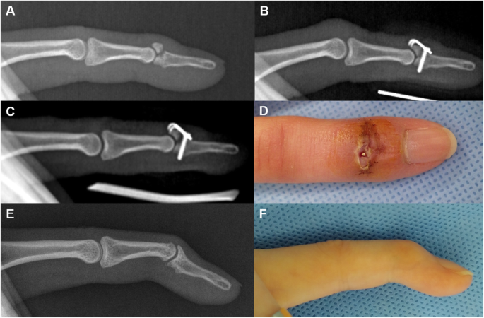 avulsion fracture finger