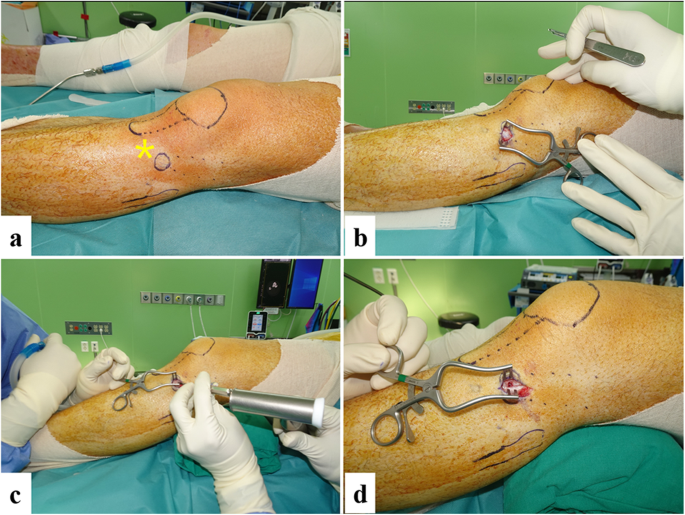 More Weighted Cancellous Bone Can Be Harvested From The Proximal Tibia With  Less Donor Site Pain Than Anterior Iliac Crest Corticocancellous Bone  Harvesting: Retrospective Review | Journal Of Orthopaedic Surgery And  Research |