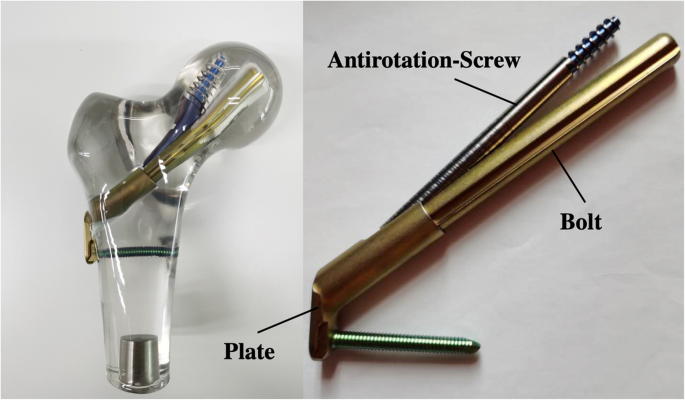 Clinical outcome of femoral neck system versus cannulated compression screws  for fixation of femoral neck fracture in younger patients | Journal of  Orthopaedic Surgery and Research | Full Text