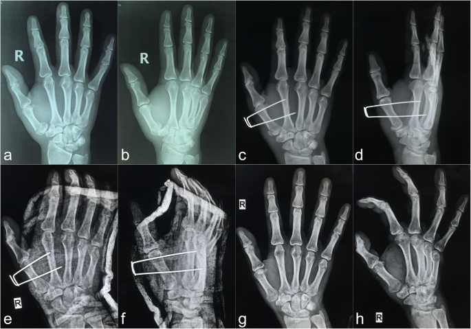 rolando vs bennett fracture