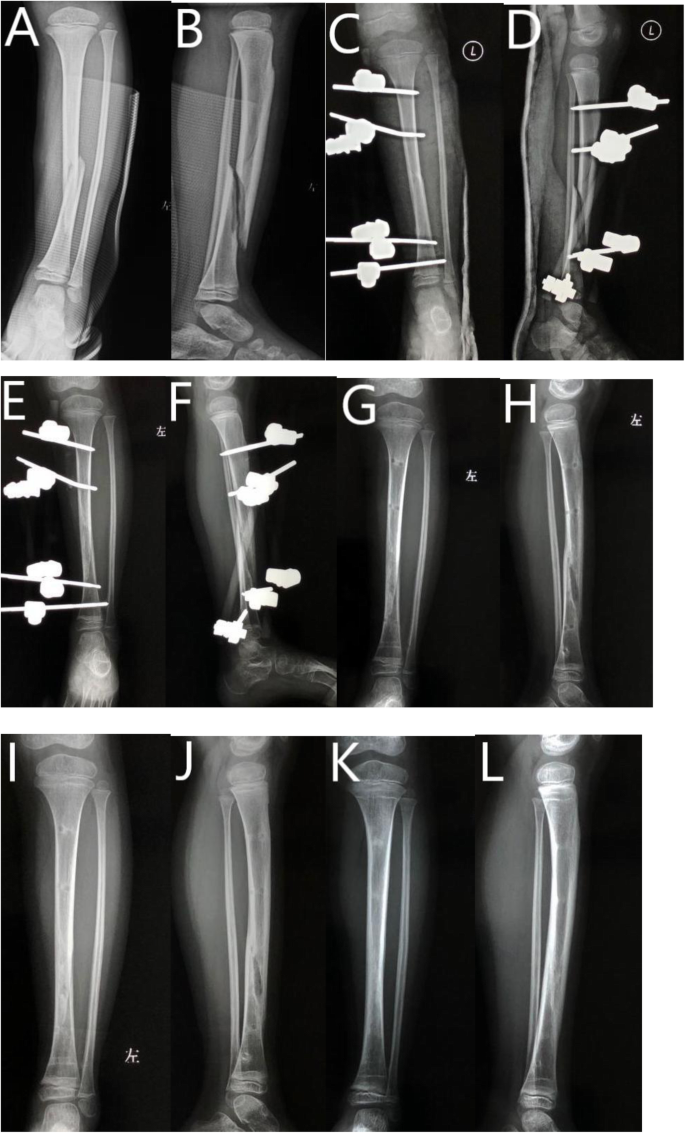 Frontiers | Elastic Stable Intramedullary Nailing and Temporary External  Fixation for the Treatment of Unstable Femoral Shaft Fractures in Children  Aged 5-11 Years Old: A Retrospective Study of 28 Cases