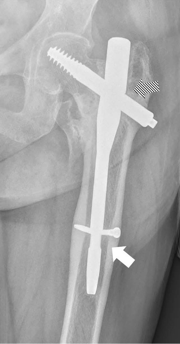 PDF Outcomes of Geriatric Hip Fractures Treated with AFFIXUS Hip Fracture  Nail  Semantic Scholar
