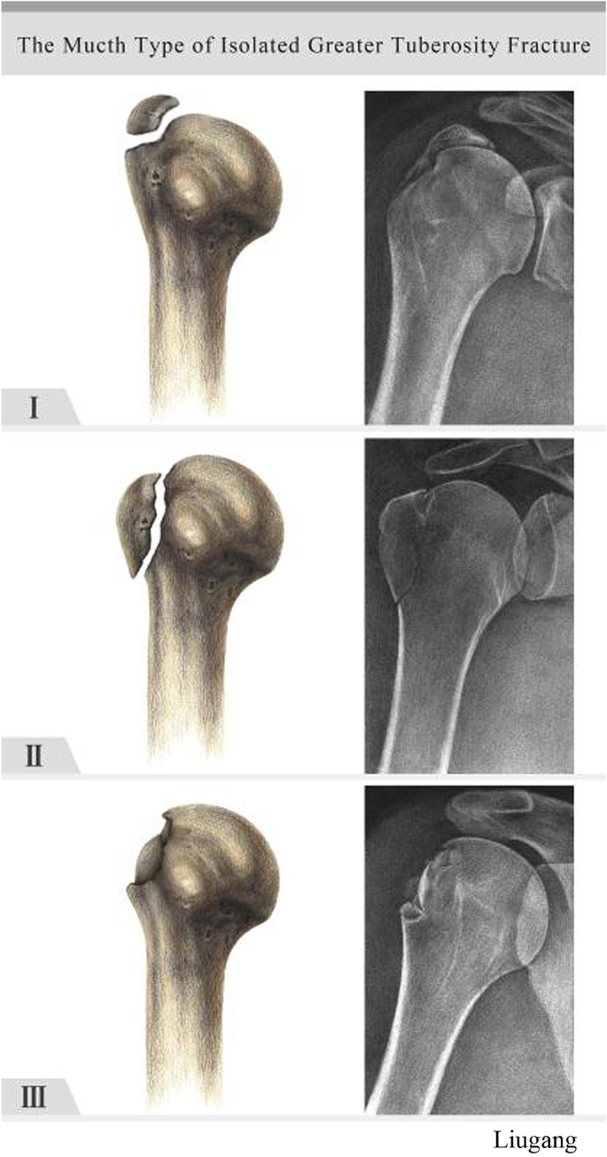 greater tubercle