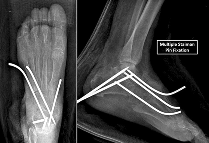 clubfoot deformity measurements x ray