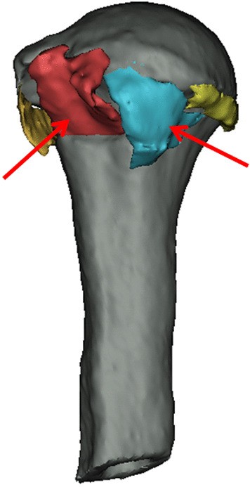 lesser tuberosity humerus