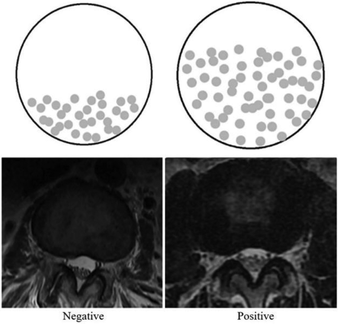 Diagnostic efficacy of nerve root sedimentation sign in post-lumbar ...