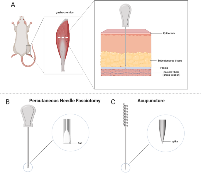 Fasciotomy Instrument Mechanistic effects of percutaneous needle fasciotomy combined with ...