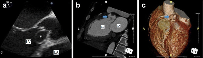 A Case Report Of Pseudoaneurysm Of Left Sinus Of Valsalva Invaded Into The Left Ventricle With Severe Aortic Regurgitation Journal Of Cardiothoracic Surgery Full Text