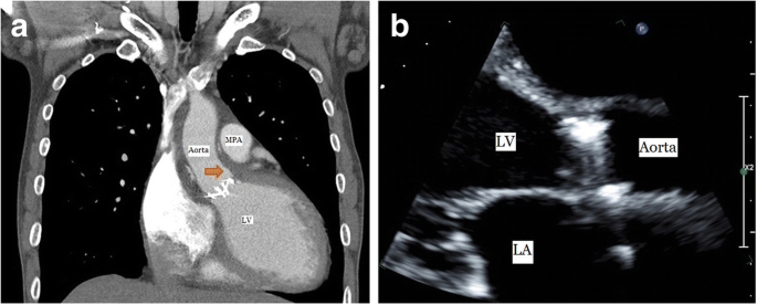A Case Report Of Pseudoaneurysm Of Left Sinus Of Valsalva Invaded Into The Left Ventricle With Severe Aortic Regurgitation Journal Of Cardiothoracic Surgery Full Text