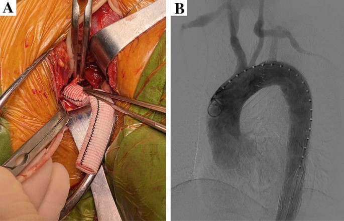 Left subclavian artery revascularization in thoracic endovascular aortic  repair: single center's clinical experiences from 171 patients | Journal of  Cardiothoracic Surgery | Full Text