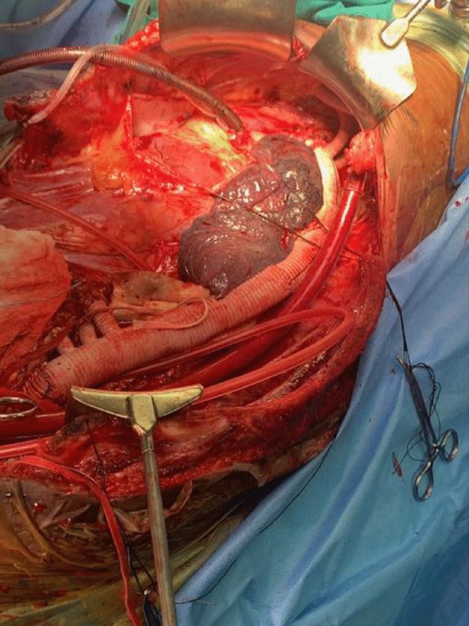 Surgeons perform triple bypass surgery on heart - Stock Image - M560/0214 -  Science Photo Library