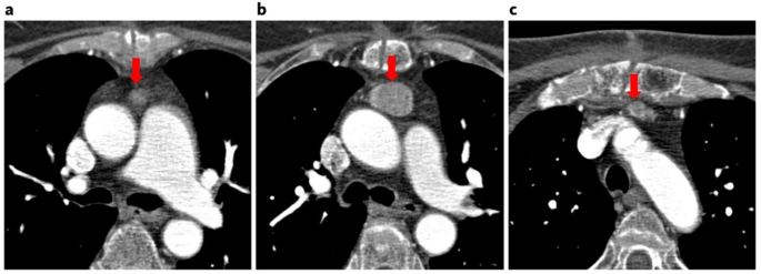 Surgical management of ectopic mediastinal parathyroid adenomas: a ...