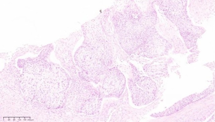 Solitary squamous cell carcinoma of the right chest wall following VATS lobectomy for NSCLC: A rare case report – Journal of Cardiothoracic Surgery