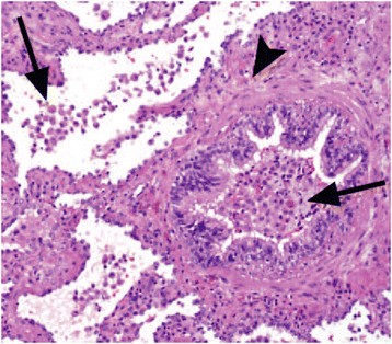 Respiratory bronchiolitis-interstitial lung disease | Orphanet Journal of  Rare Diseases | Full Text