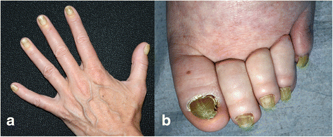 Yellow nail syndrome: a review | Orphanet Journal of Rare Diseases | Full  Text