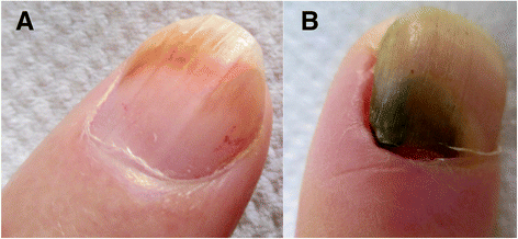 Transient yellow discoloration of the nails for differential diagnosis with yellow  nail syndrome | Orphanet Journal of Rare Diseases | Full Text