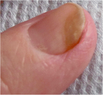 Transient yellow discoloration of the nails for differential diagnosis with yellow nail syndrome | Orphanet Journal of Rare Diseases | Full Text Transient yellow discoloration of the nails for differential diagnosis with yellow nail syndrome | Orphanet Journal of Rare Diseases | Full Text
