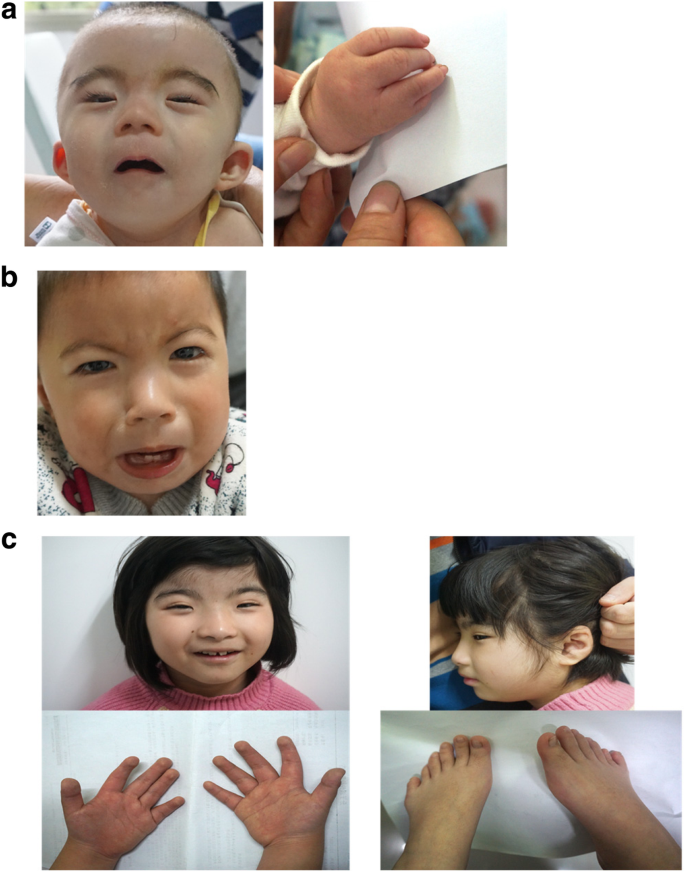 Mosaic CREBBP mutation causes overlapping clinical features of