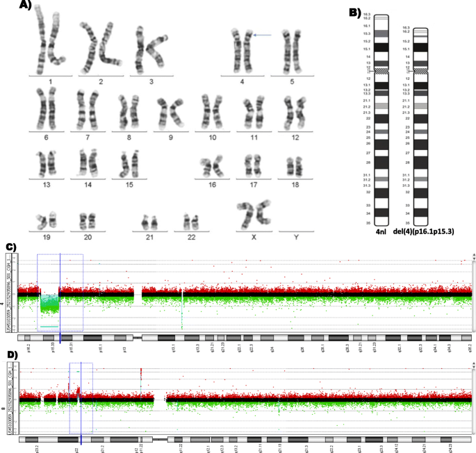Genetic And Clinical Characterization Of 73 Pigmentary Mosaicism Patients Revealing The Genetic Basis Of Clinical Manifestations Orphanet Journal Of Rare Diseases Full Text
