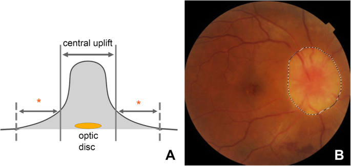 papilledema vs glaucoma