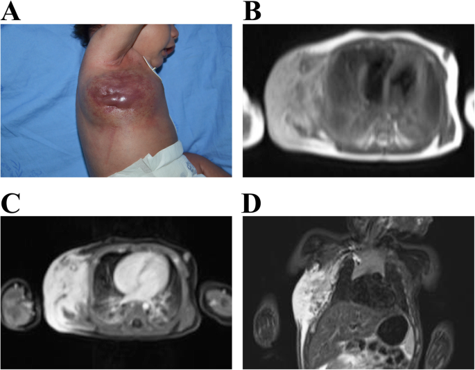 Exophyticus condyloma van a méhnyakamon pikkelyes bőrrák