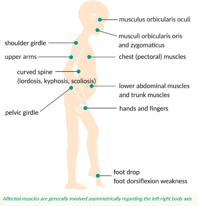 Facioscapulohumeral muscular dystrophy: genetics, gene activation and  downstream signalling with regard to recent therapeutic approaches: an  update | Orphanet Journal of Rare Diseases | Full Text