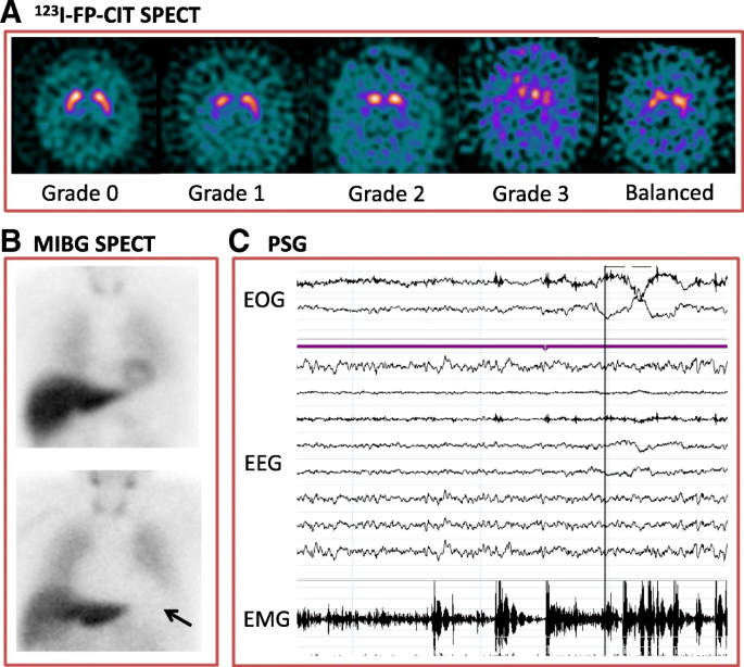 Dementia with Lewy bodies: an update and outlook | Molecular  Neurodegeneration | Full Text