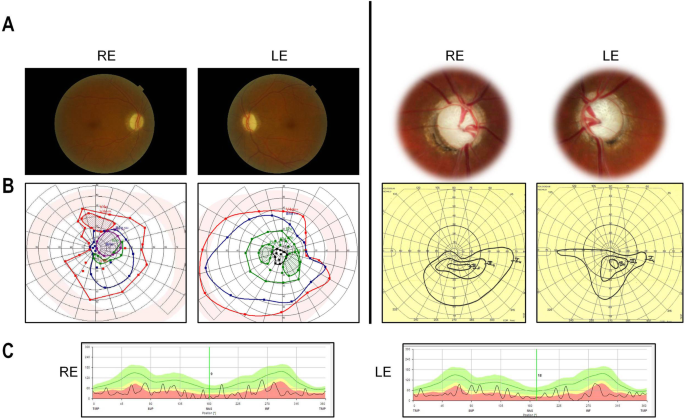 Dominant Mutations In Mief1 Affect Mitochondrial Dynamics And Cause A Singular Late Onset Optic Neuropathy Springerlink