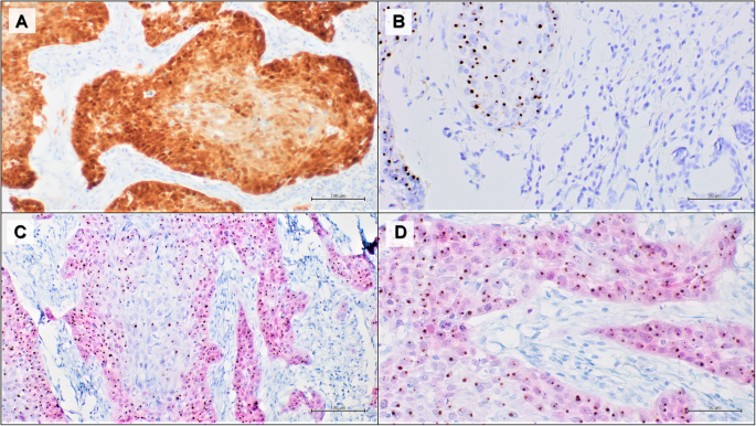 hpv és p16