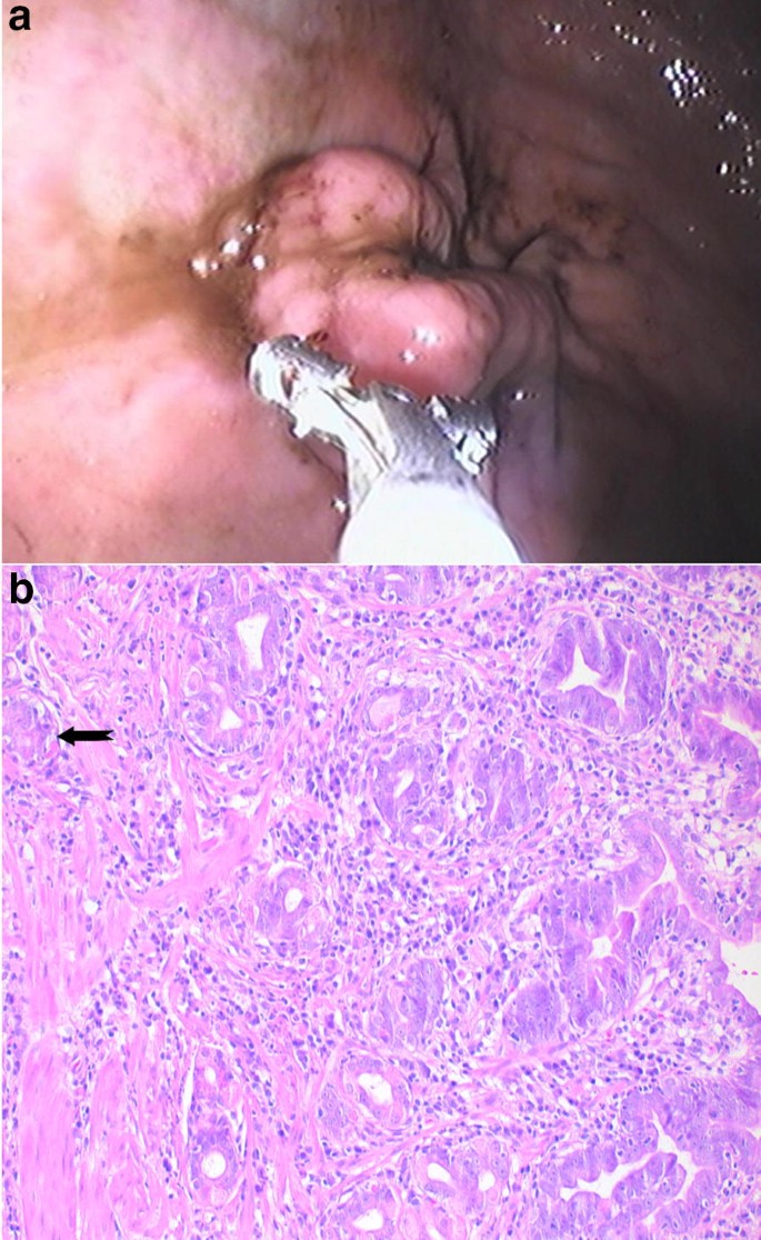 Histological analysis of the anal transition zone