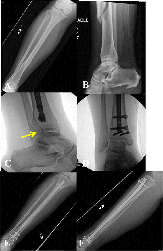 Safe surgical technique: intramedullary nail fixation of tibial shaft fractures | Patient Safety in Surgery | Full Text Safe surgical technique: intramedullary nail fixation of tibial shaft fractures | Patient Safety in Surgery | Full Text