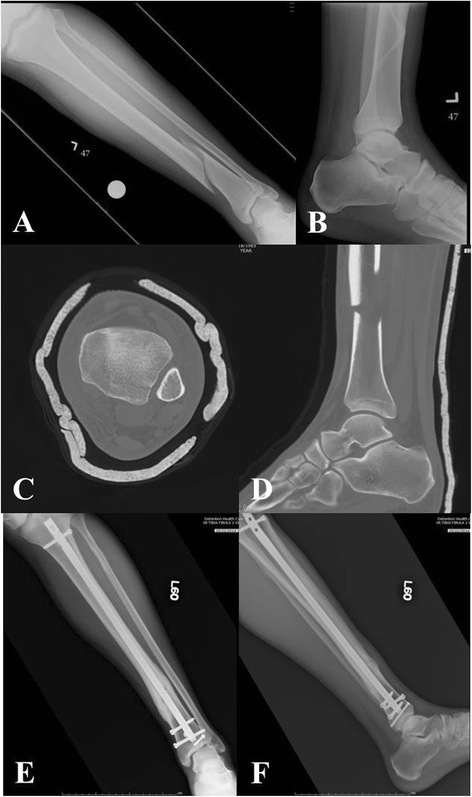 Safe surgical technique: intramedullary nail fixation of tibial shaft  fractures | Patient Safety in Surgery | Full Text
