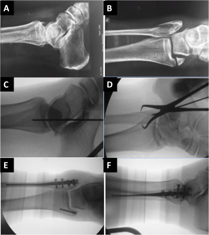 Safety and efficacy of surgical fixation of fibula fractures using an  intramedullary nail: a retrospective observational cohort study in 30  patients | Patient Safety in Surgery | Full Text