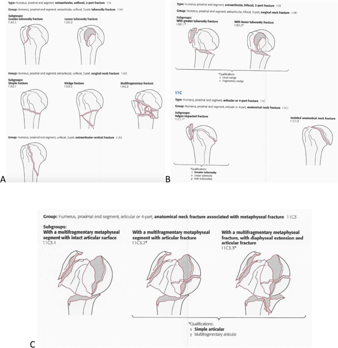 Three-dimensional models increase the interobserver agreement for the  treatment of proximal humerus fractures | Patient Safety in Surgery | Full  Text