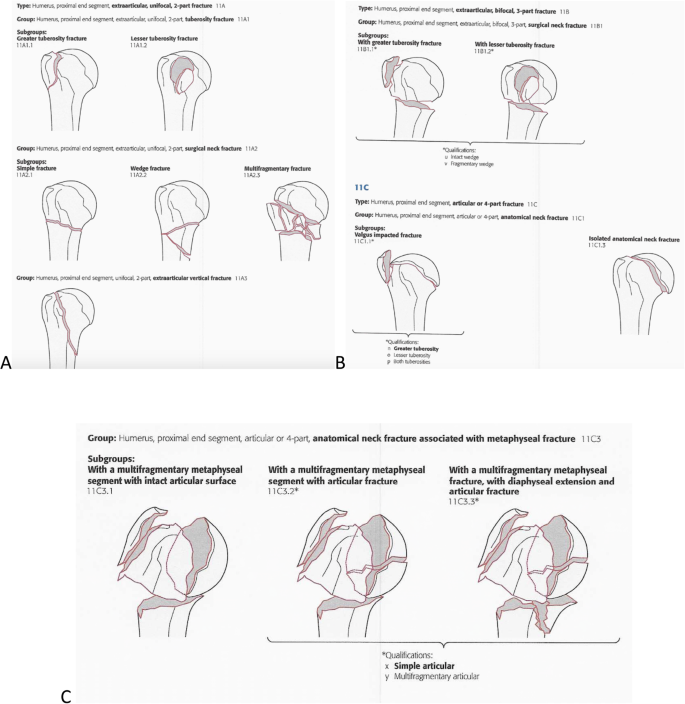 Three Dimensional Models Increase The Interobserver Agreement For The Treatment Of Proximal Humerus Fractures Patient Safety In Surgery Full Text