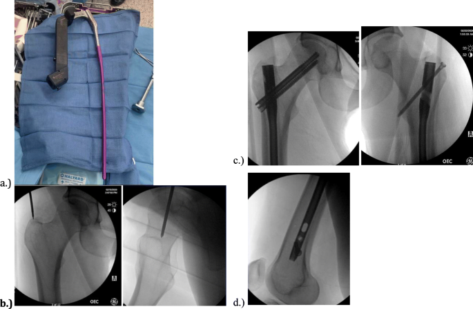 Safety and efficacy of a novel cephalomedullary nail in femoral shaft  fractures: a retrospective observational cohort in 33 patients | Patient  Safety in Surgery | Full Text