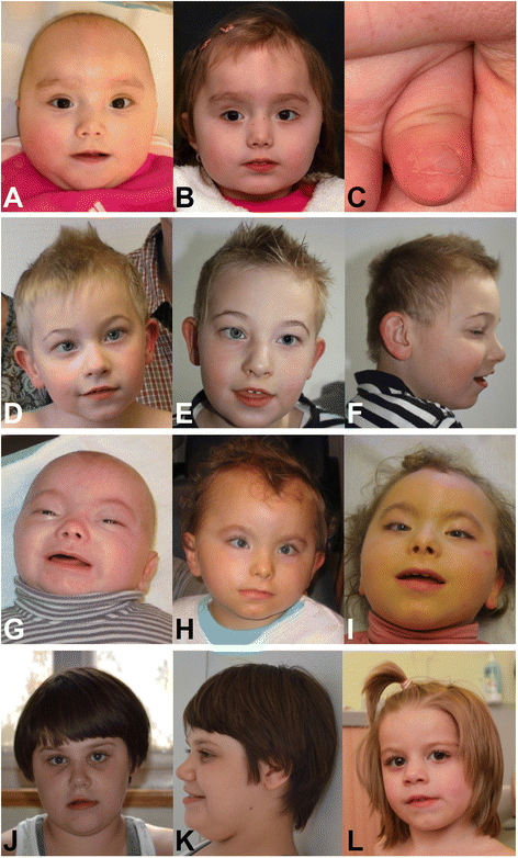 Chromosome 16p13.3 Contiguous Gene Deletion Syndrome including the SLX4,  DNASE1, TRAP1, and CREBBP Genes Presenting as a Relatively Mild Rubinstein- Taybi Syndrome Phenotype: A Case Report of a Saudi Boy. - Document 