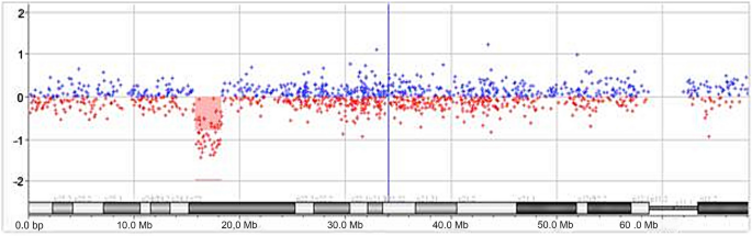 Partial deletion of chromosome 6p causing developmental delay and mild  dysmorphisms in a child: molecular and developmental investigation and  literature search | Molecular Cytogenetics | Full Text