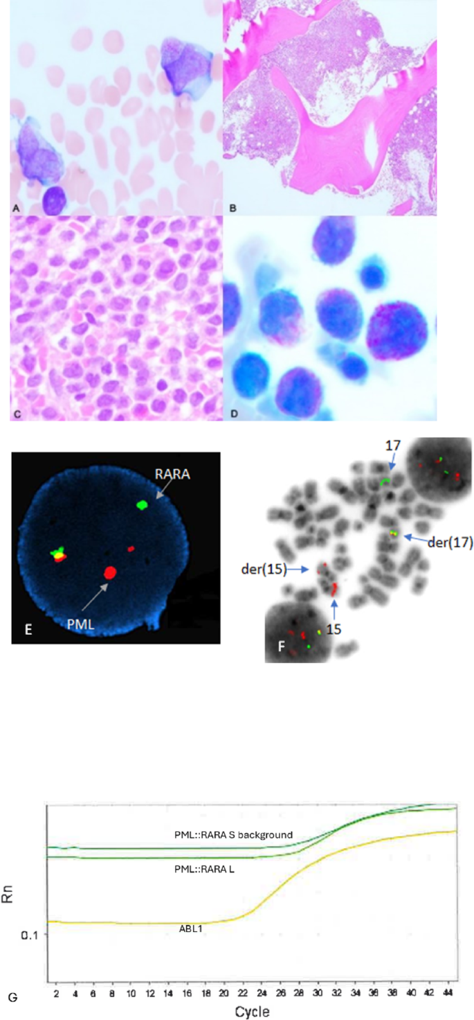 Rare single PML::RARA fusion transcript from insertion on derivative ...